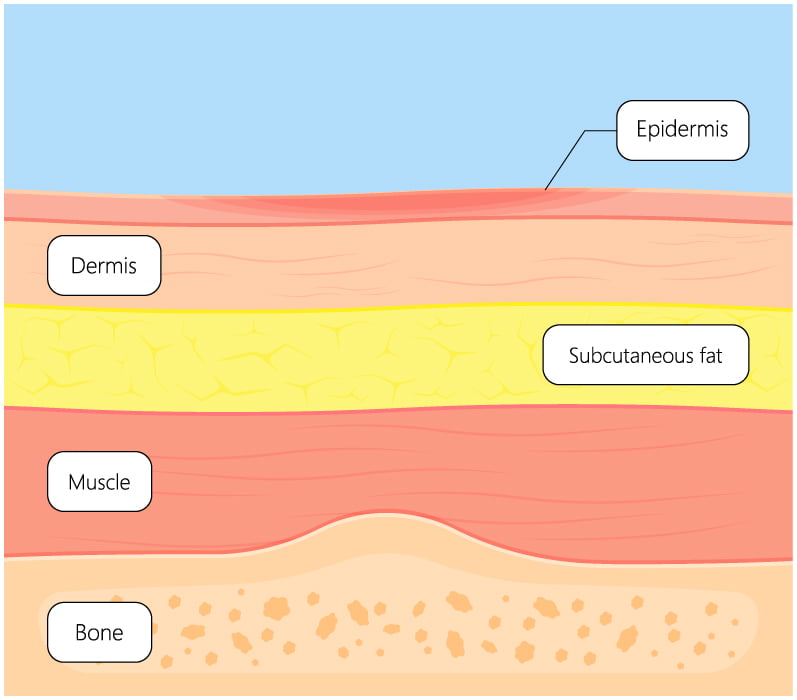Diagram of a stage one bed sore