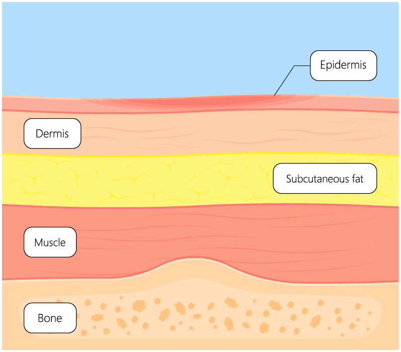Diagram of a stage one bed sore