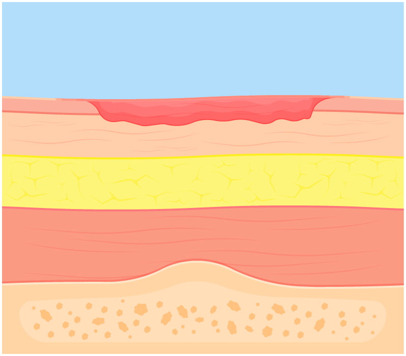 Diagram of a stage two bed sore