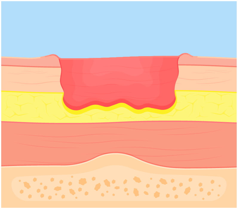 Diagram of a stage three bed sore