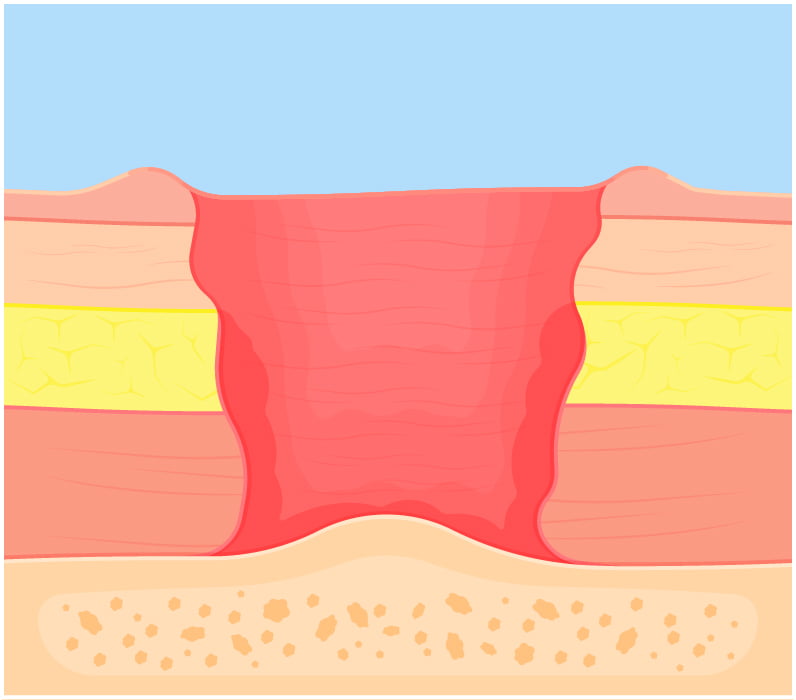 Diagram of a stage four bed sore