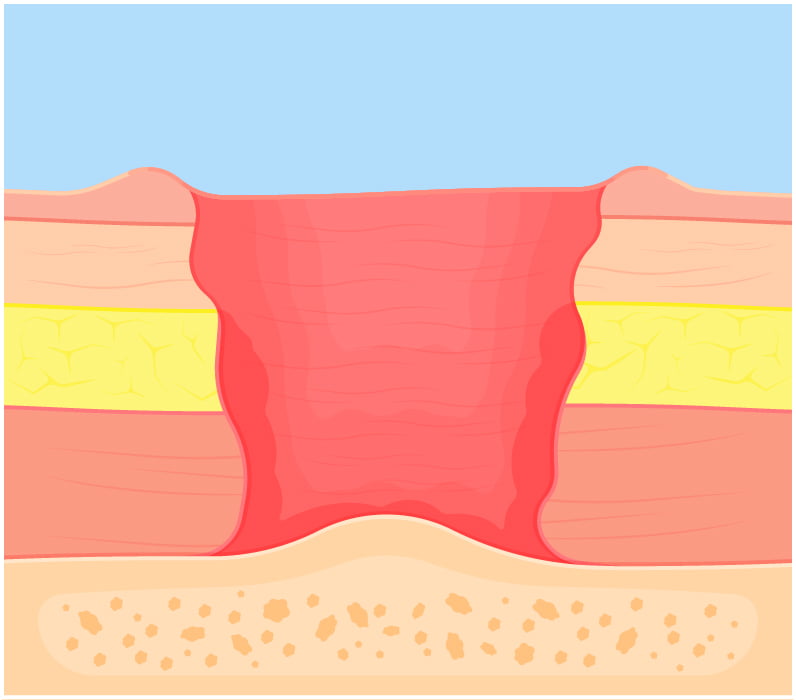 Diagram of a stage four bed sore